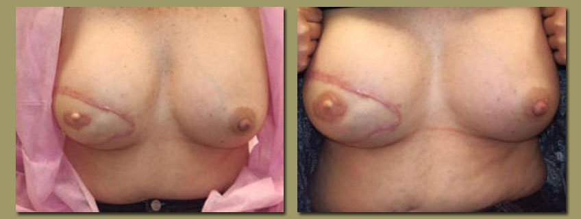  other breast surgery or who may have irregular or fading areolas 